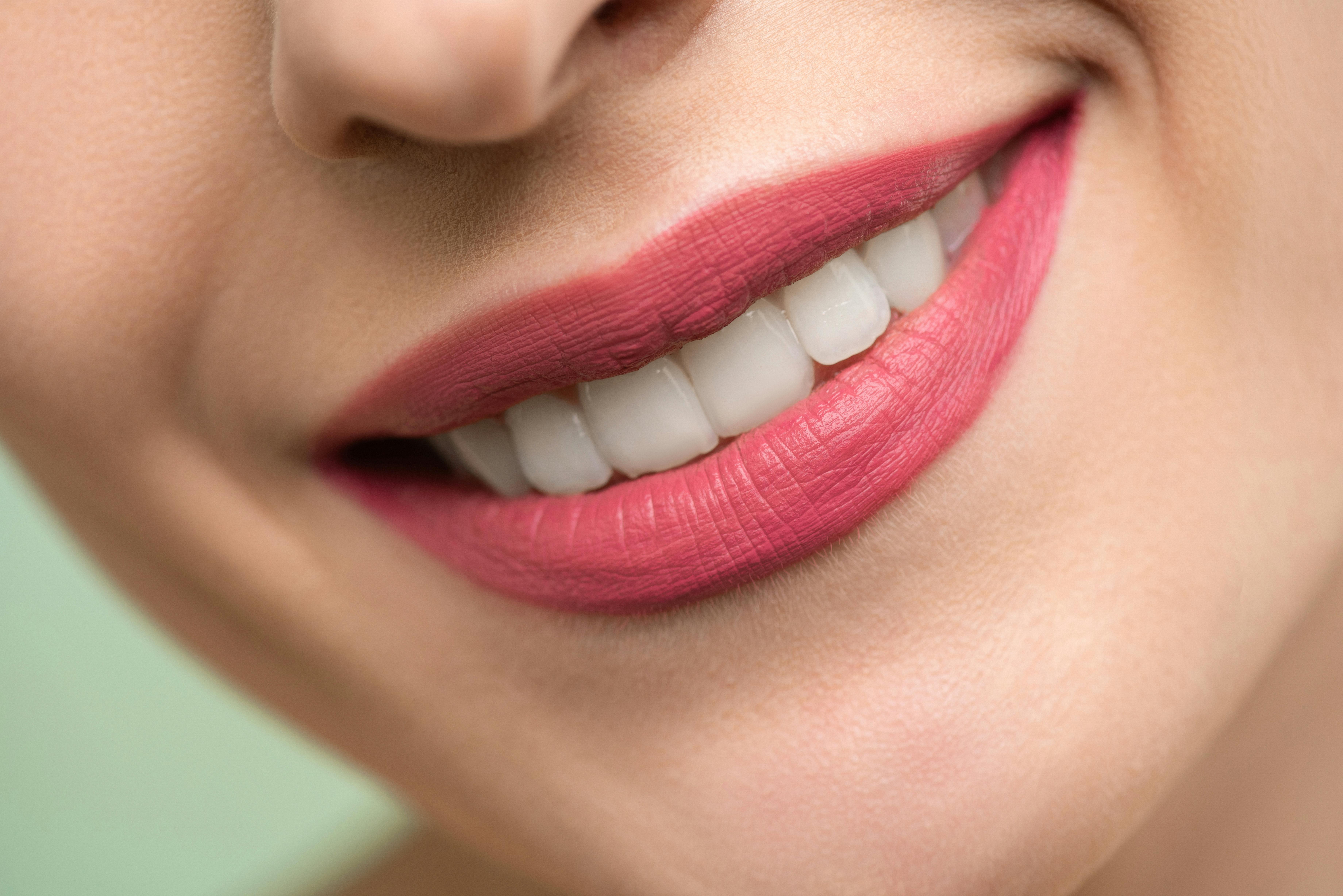 Sorriso com dentes mais claros após clareamento dental