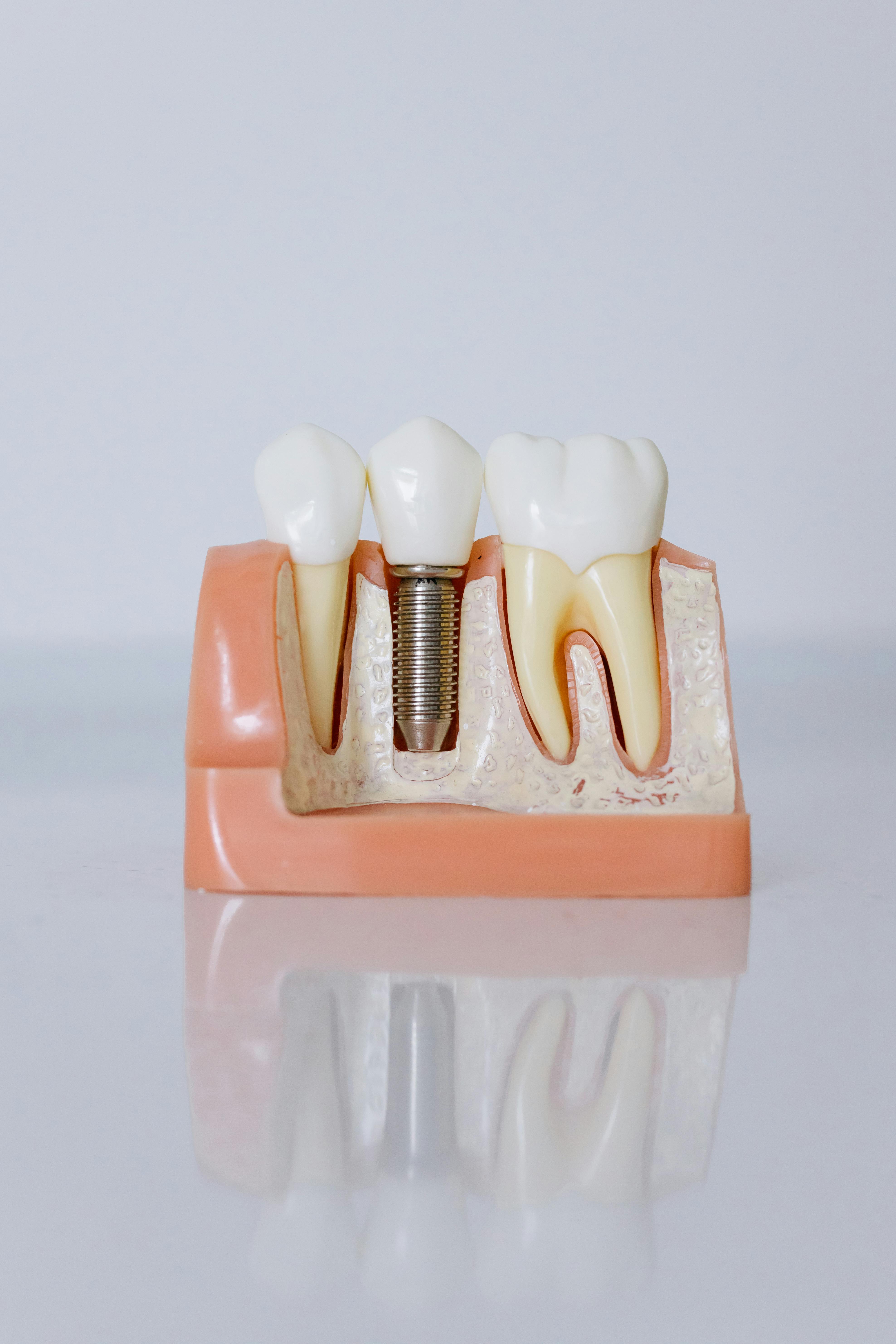 Procedimento odontológico com foco em implantes dentários