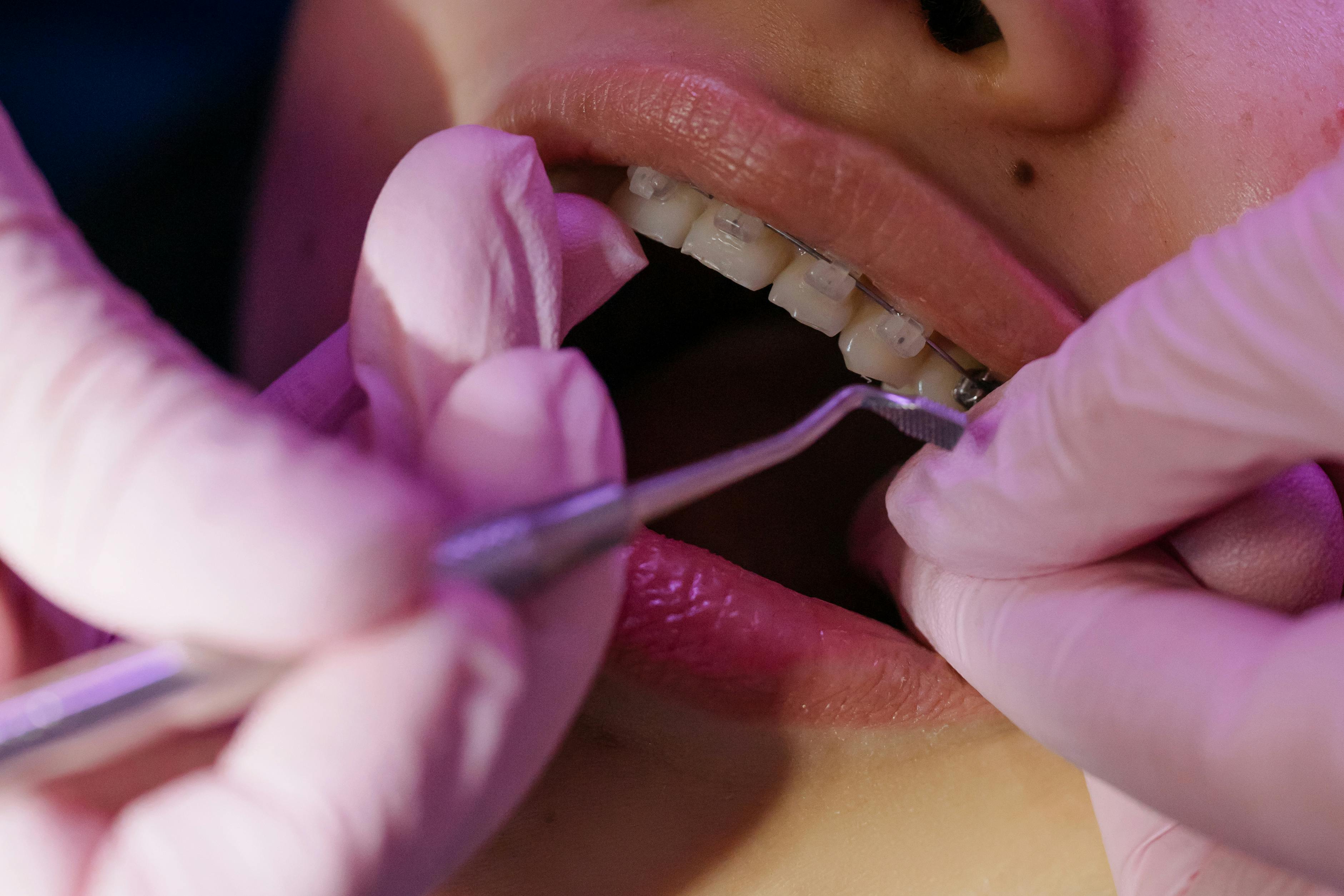 Aparelho ortodôntico em tratamento de alinhamento dental